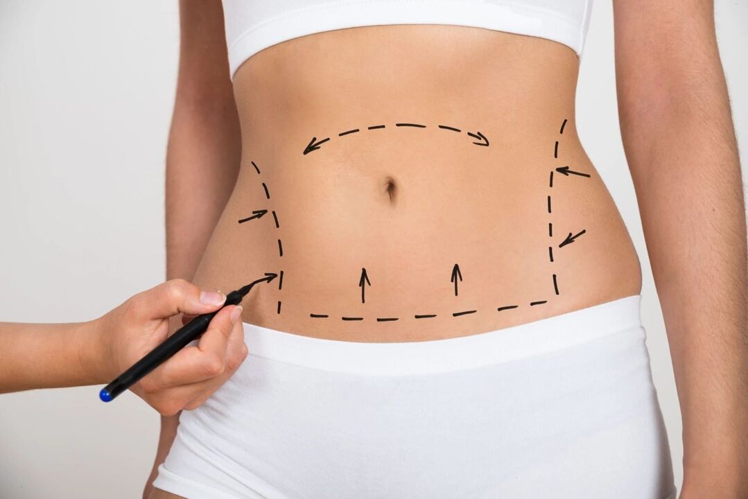 Marking on the abdomen before liposuction, correcting the figure